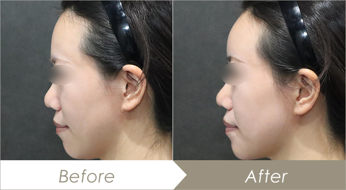 額(おでこ)ヒアルロン酸注入の施術例（リフト™リド 2本）-症例写真