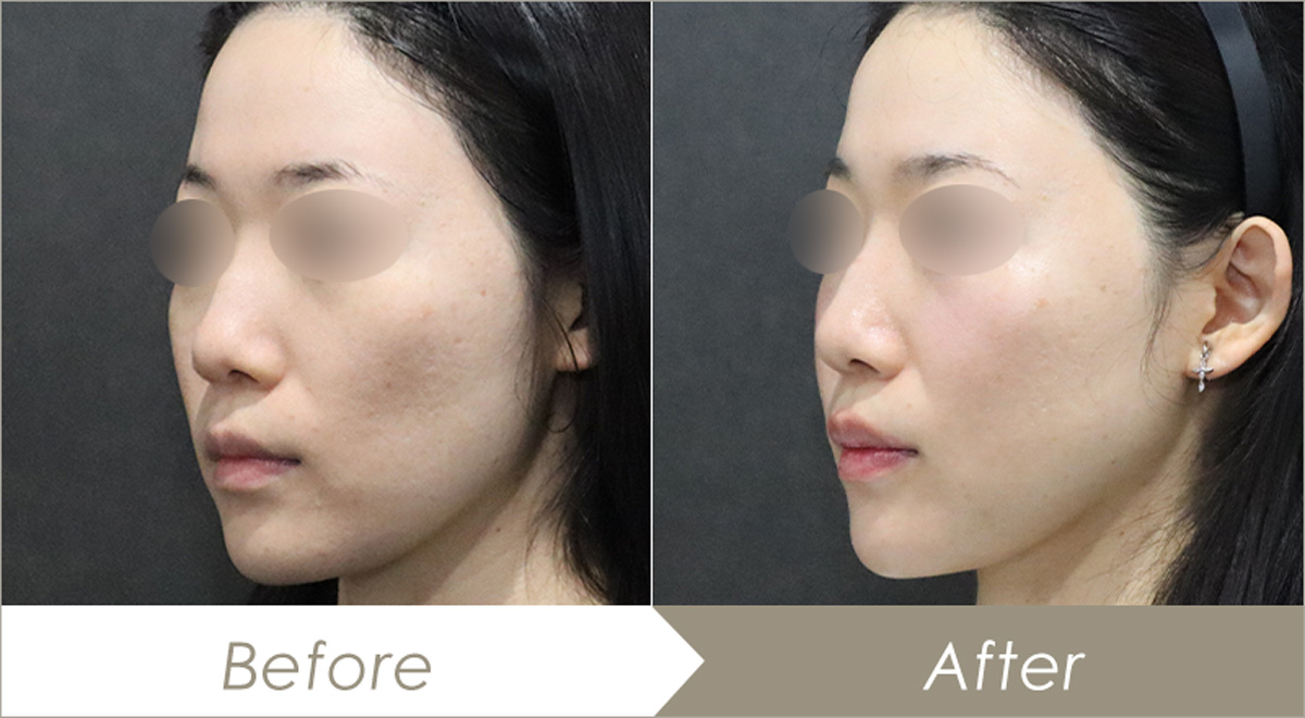 脂肪吸引注射（併せて行った施術：糸リフト（アンカーX4本））の施術例-症例写真