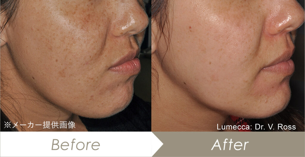 ルメッカの施術症例（メーカー提供画像）