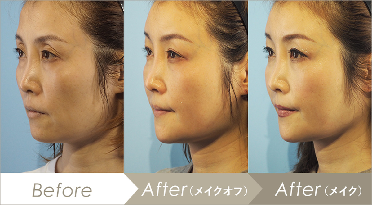 スキンボトックス（マイクロボトックス）の施術例-症例写真