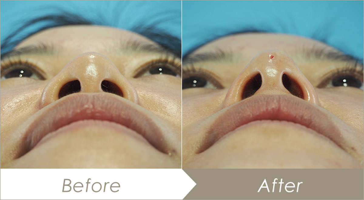 テスリフトノーズ4本（鼻柱2本・鼻背2本）の施術例-症例写真