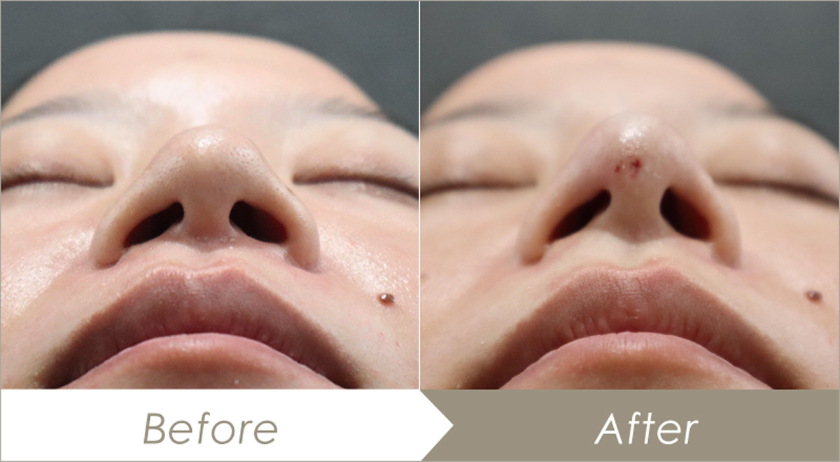 G-Cog nose6本（鼻背4本・鼻柱2本）の施術例-症例写真