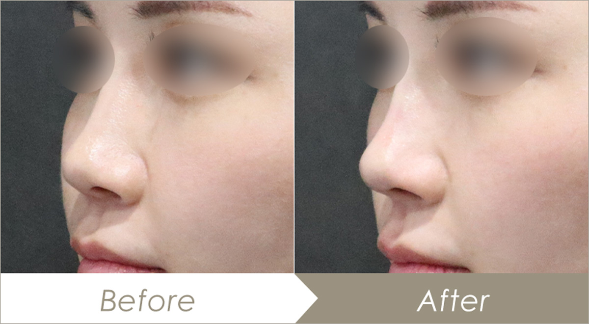 テスリフトノーズ（鼻背3本・鼻柱3本）の施術例 – 症例写真