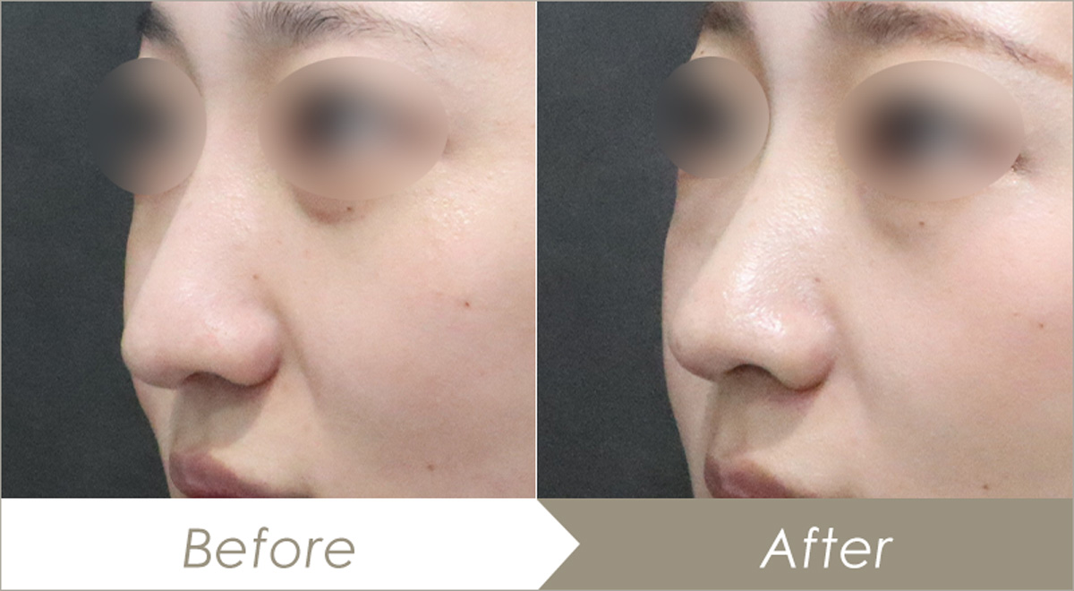 テスリフトノーズ（鼻柱3本）の施術例 – 症例写真