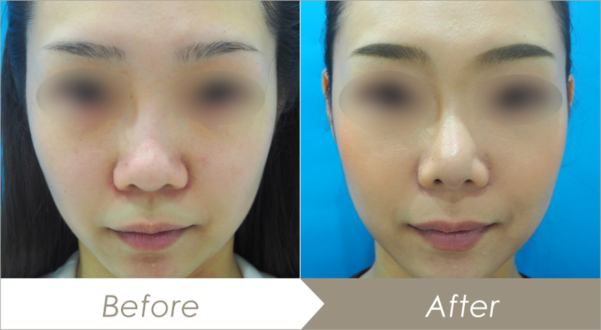 鼻尖形成術（オープン法）と耳介軟骨移植(鼻)の施術例-症例写真