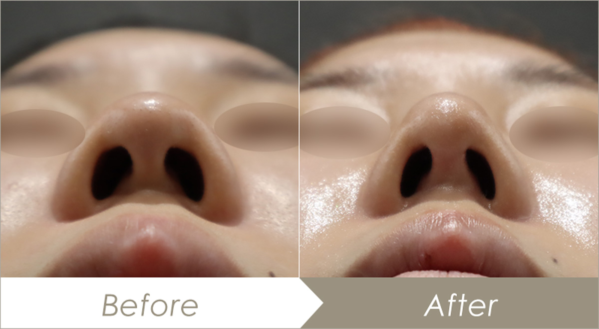 鼻尖形成術（鼻尖縮小術）の施術例（併せて行った施術：耳介軟骨移植(鼻)・鼻プロテーゼ(隆鼻術)）-症例写真