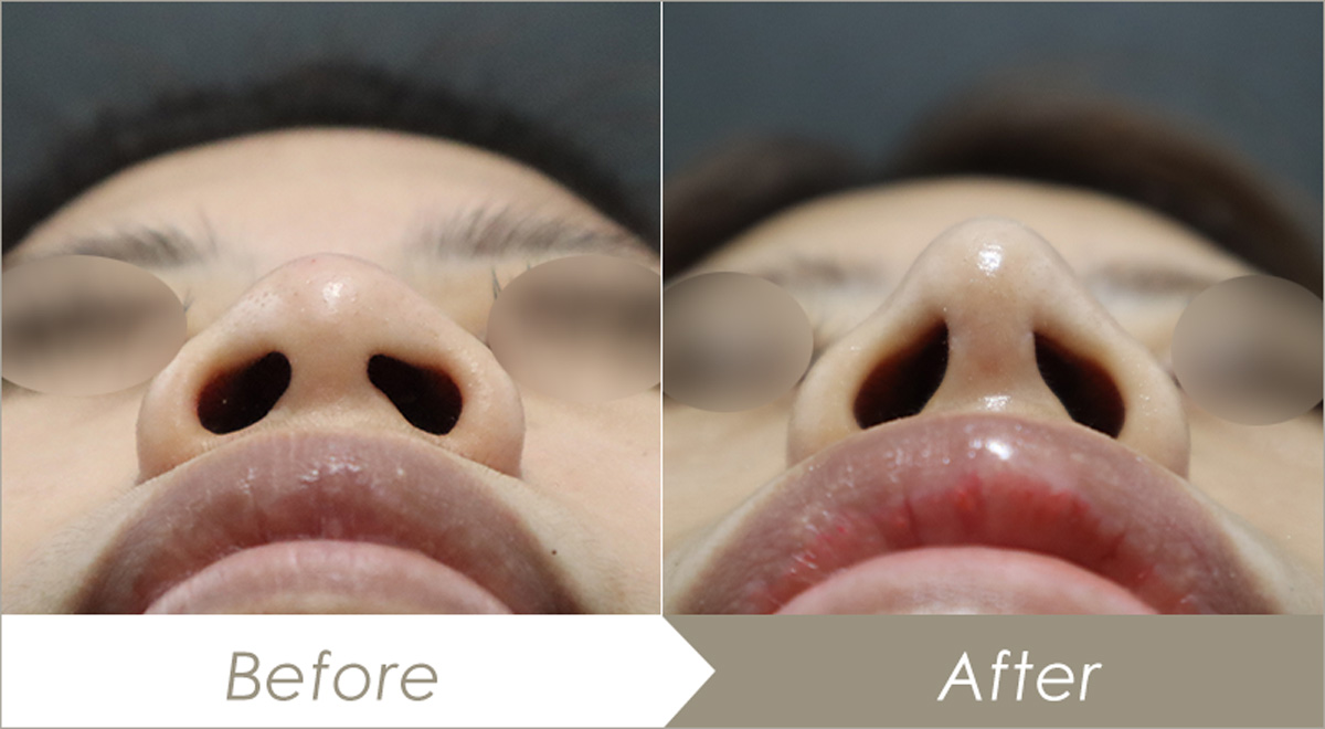 鼻尖形成術（鼻尖縮小術）の施術例（併せて行った施術：鼻プロテーゼ(隆鼻術)・耳介軟骨移植(鼻)）-症例写真