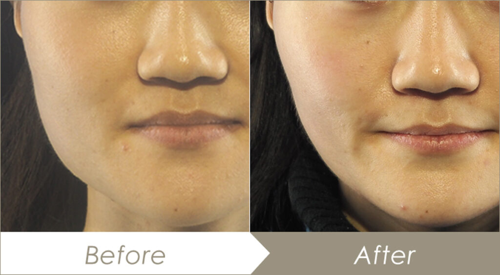 エラボトックスの施術例