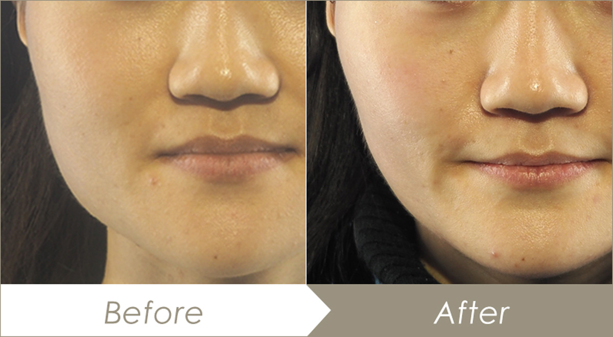 エラボトックスの施術例（ボトックスビスタ 標準）-症例写真