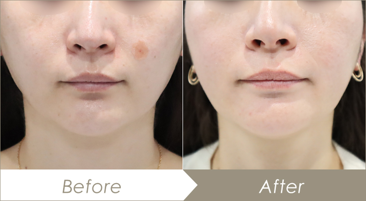 エラボトックスの施術例（ボトックスビスタ 標準使用）-症例写真