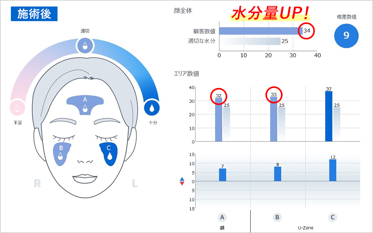 プルリアル デンシファイ施術後の水分量