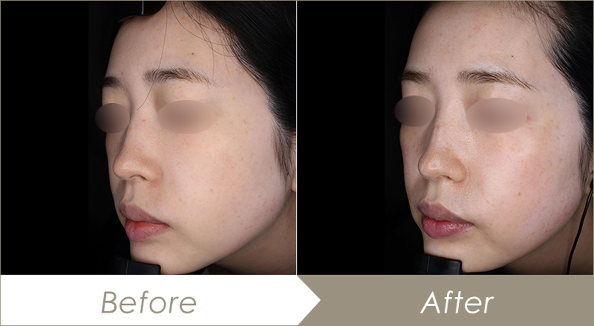 プルリアル デンシファイ（水光注射使用）-症例写真