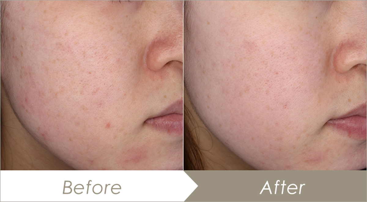 PRP皮膚再生（多血小板血漿）療法の症例