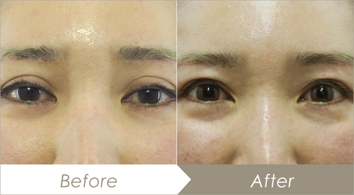 眼瞼下垂手術の施術例-症例写真