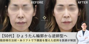 【50代】ひょうたん輪郭から逆卵型へ｜脂肪吸引注射×糸リフトで下顔面を整えた症例を安形医師が解説