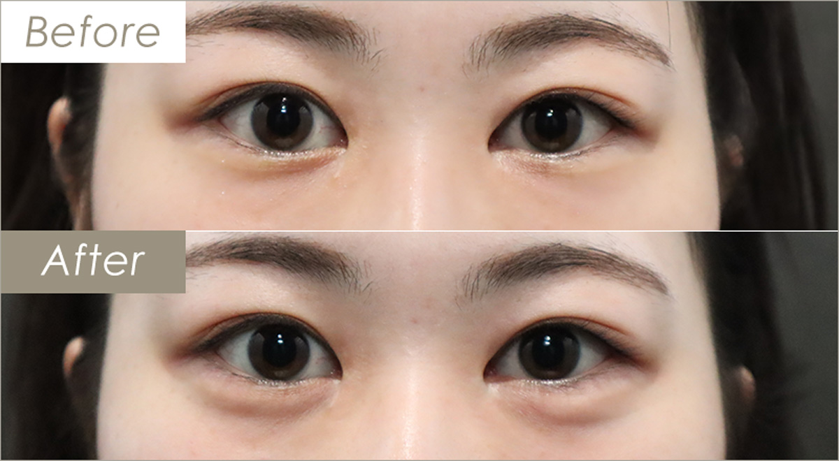 涙袋ヒアルロン酸注射の施術例-症例写真