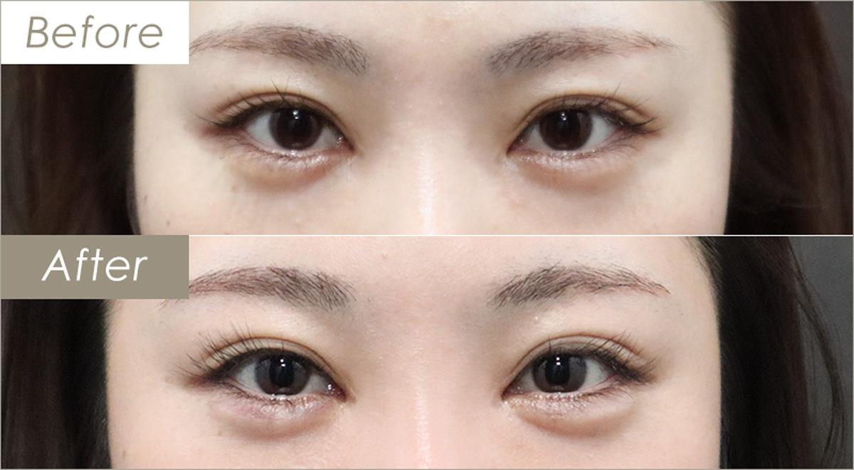 涙袋ヒアルロン酸注射の施術例（ボルベラXC1本） – 症例写真