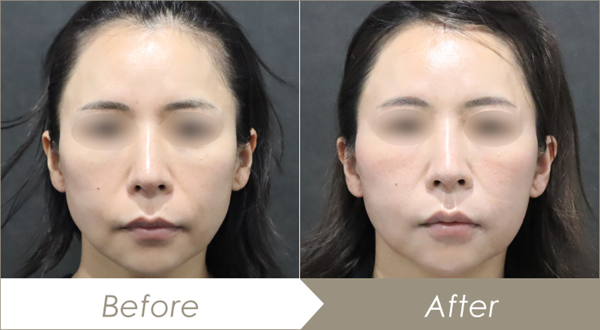 テスリフト（TESS LIFT）の施術例-症例写真