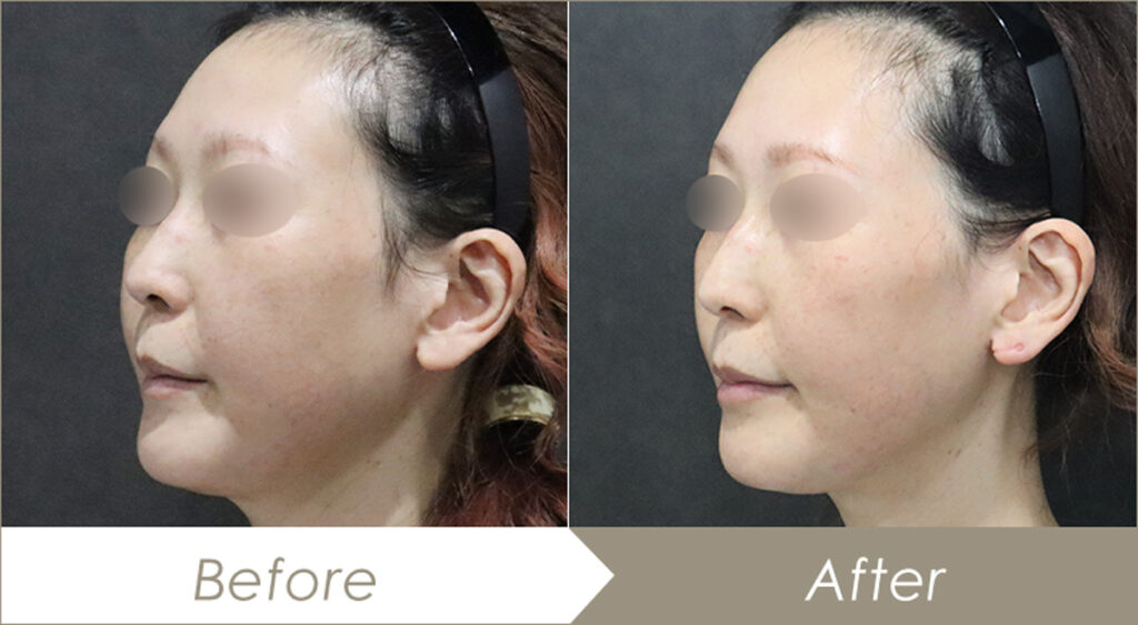 テスリフト（TESS LIFT）（併せて行った施術：脂肪吸引注射）の施術例