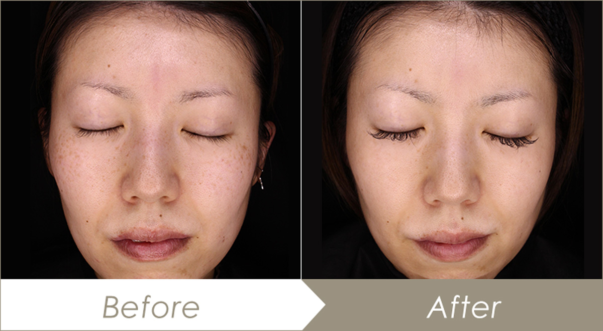 レーザートーニング(メドライトC6)の施術例(10回肝斑・シミ・毛穴・くすみ改善) – 症例写真