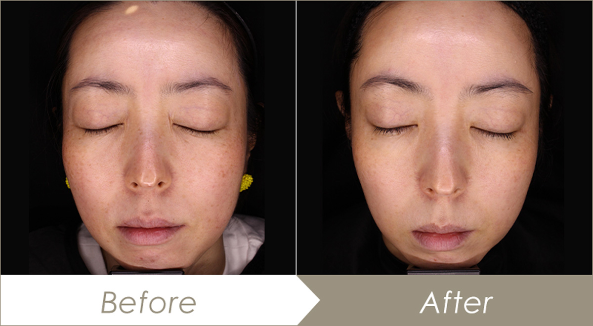 レーザートーニング(メドライトC6)の施術例(10回セット) – 症例写真