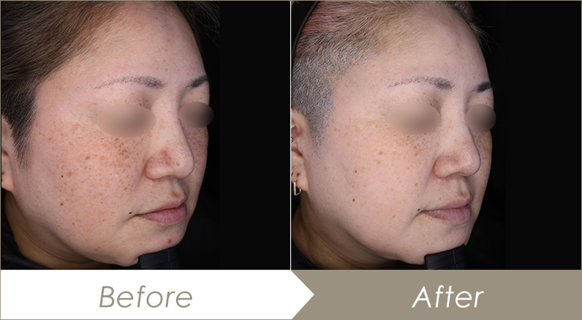 レーザートーニング(メドライトC6)の施術例(全顔10回) – 症例写真