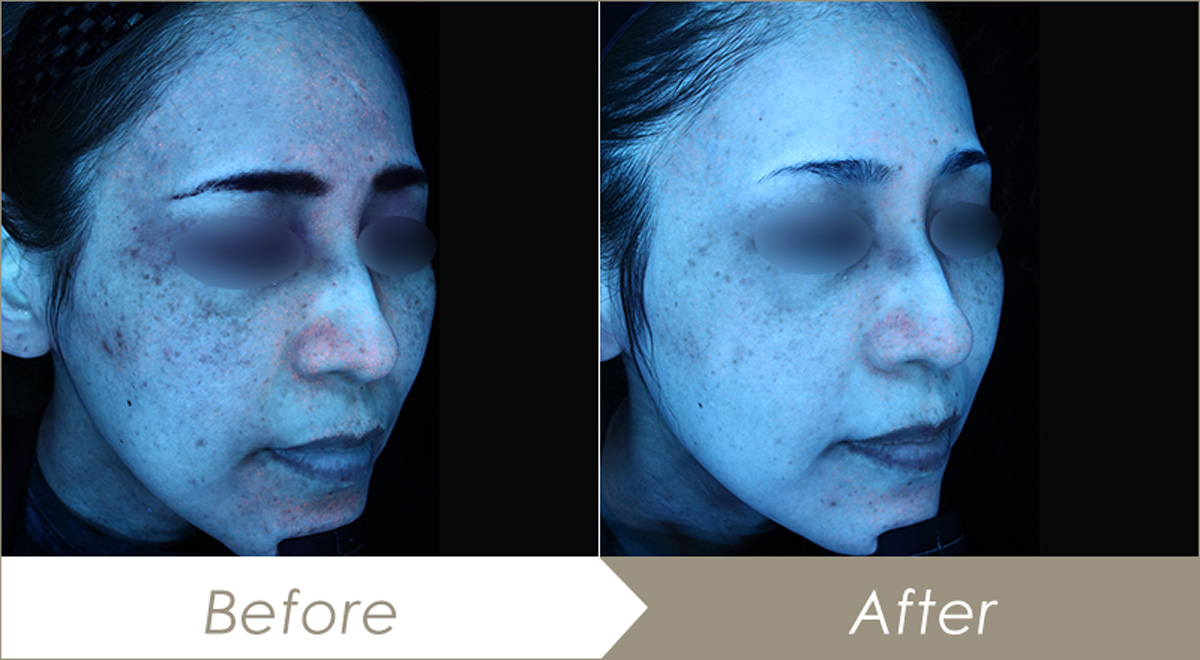 レーザートーニング(メドライトC6)の施術例(20回) – 症例写真