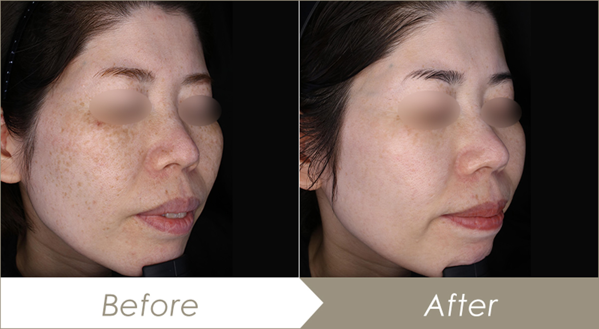 レーザートーニング(メドライトC6)20回の施術例 – 症例写真