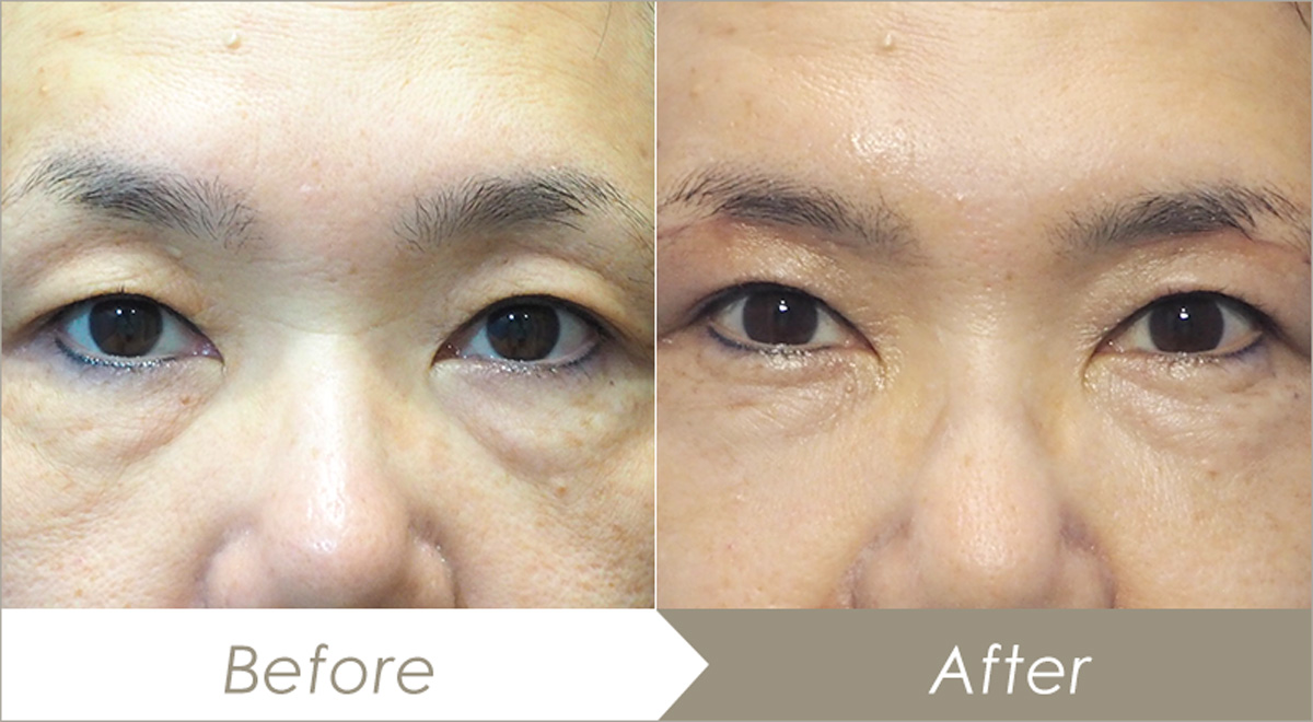 眉下切開（眉下リフト）の施術例-症例写真