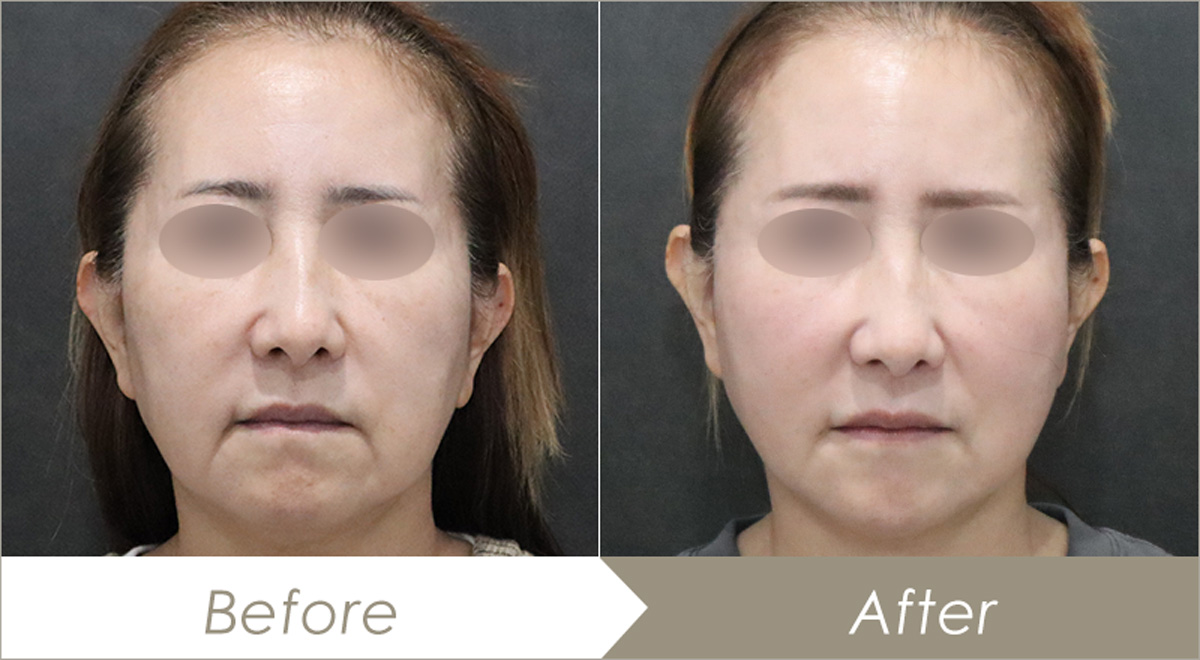 ヒアルロン酸リフトの施術例（併せて行った施術：テスリフト6本）-症例写真