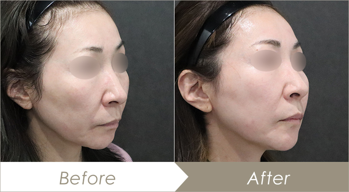 ヒアルロン酸リフトの施術例（ボリューマXC2本・ボリフトXC1本・ボラックスXC1本）-症例写真