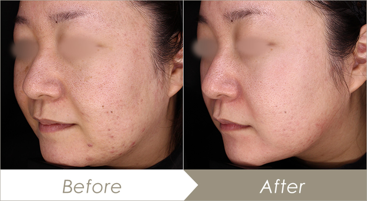 ゼオスキンを使用前と使用後の比較写真