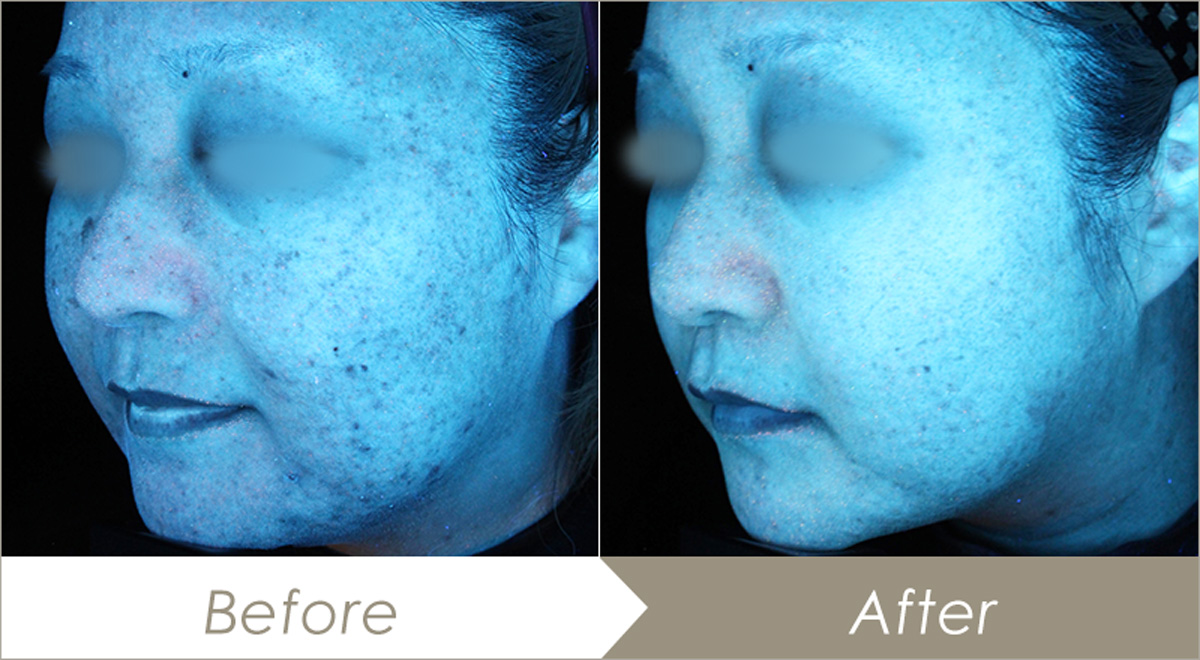 ゼオスキンを使用前、使用後の比較レビュー比較写真