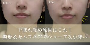下膨れ顔の原因はこれ！整形＆セルフケアで シャープな小顔へ