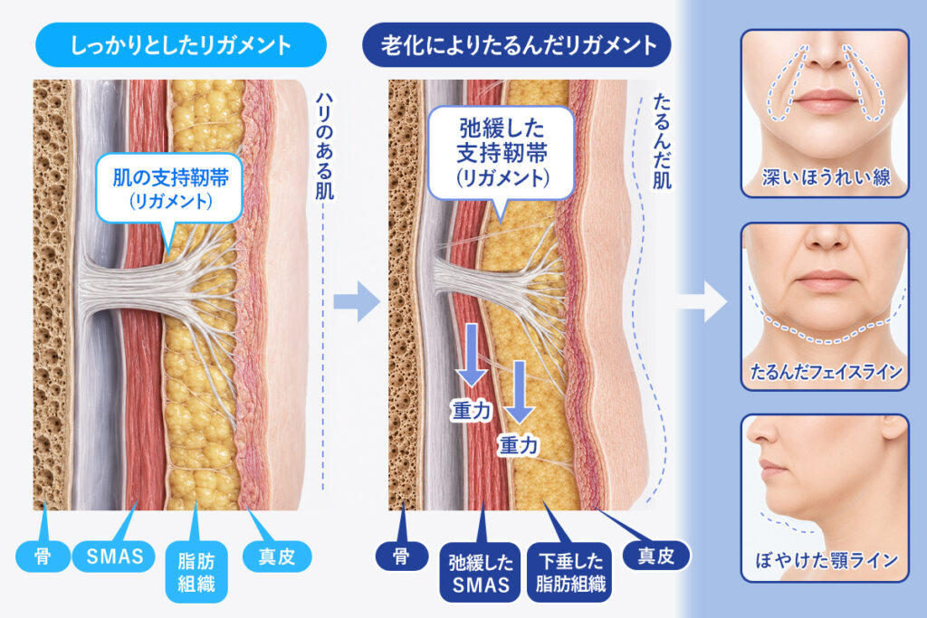 リガメントがたるむと、ほうれい線、顎ライン、フェイスラインがくずれます。