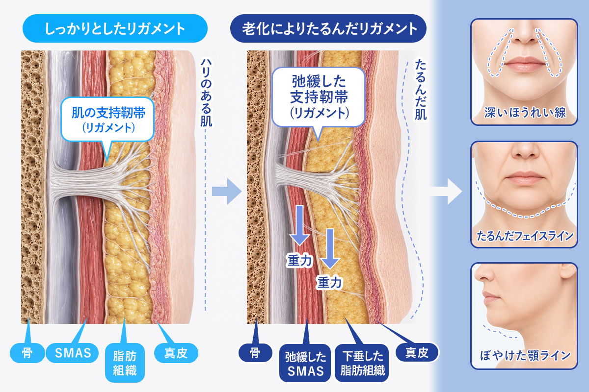 リガメントがたるむと、ほうれい線、顎ライン、フェイスラインがくずれます。