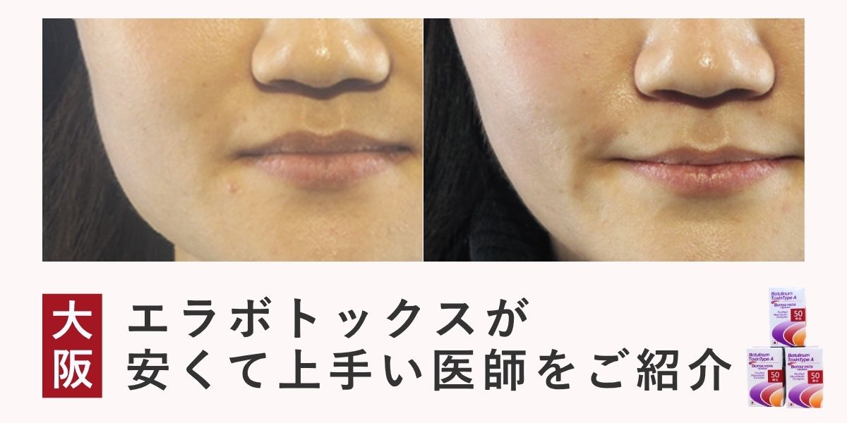 【大阪】エラボトックスが安くて上手い医師のご紹介