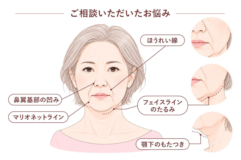 ほうれい線が最も気になる/フェイスラインのたるみ/マリオネットライン/下のもたつき・鼻翼基部の凹み