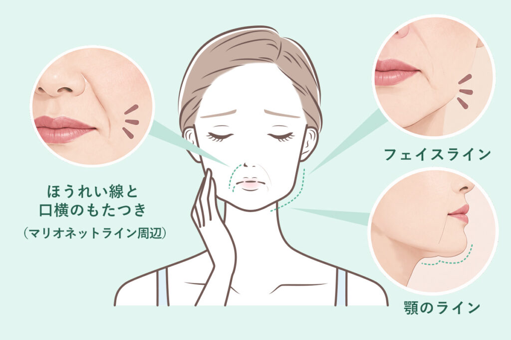 ほうれい線や口横のもたつき、フェイスラインが気になるなど患者様の来院時のお悩み