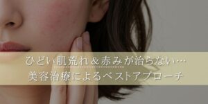 ひどい肌荒れ＆赤みが治らない…美容治療によるベストアプローチ