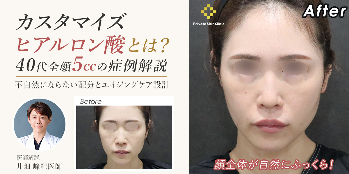 カスタマイズヒアルロン酸とは？40代全顔5ccの症例解説｜不自然にならない配分とエイジングケア設計