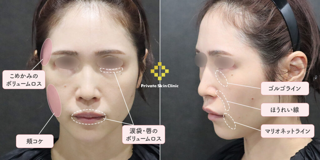 定期的にヒアルロン酸によるメンテナンスを受けている40代女性のお悩み