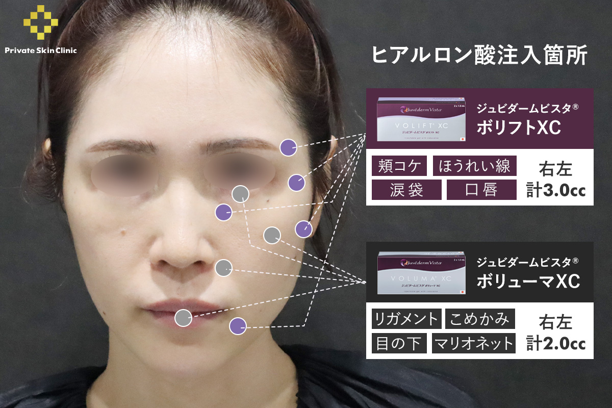 40代女性のヒアルロン酸注入箇所