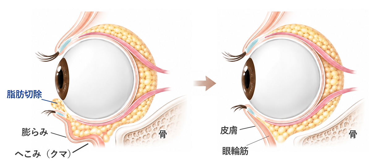 下瞼脂肪取りで「眼窩内脂肪」を下まぶたの裏側から取り除く