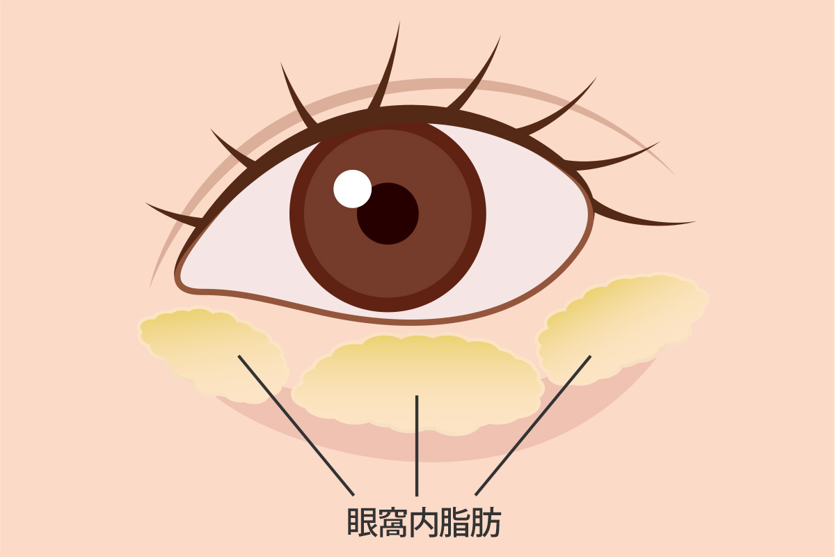眼窩内脂肪