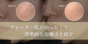 クレーター肌が治った！？効果的な治療法を紹介