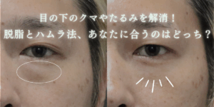 脱脂とハムラ法、あなたに合うのはどっち？