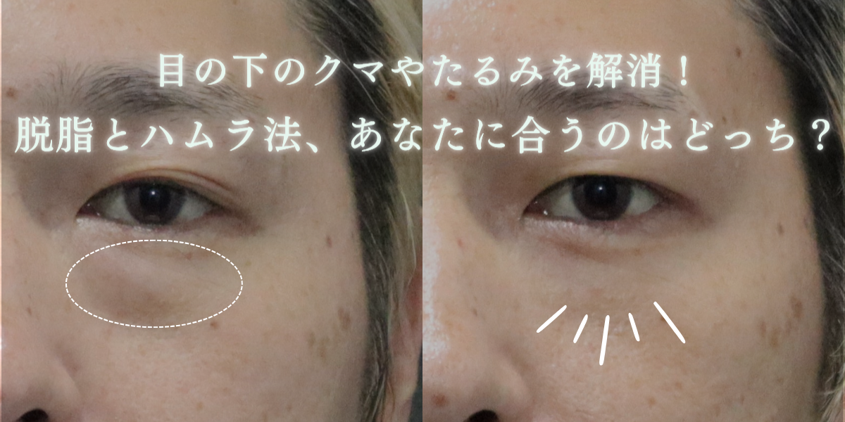 脱脂とハムラ法について徹底比較