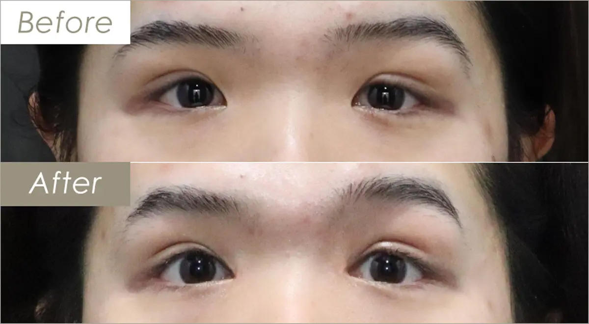 目頭切開法（Ｚ形成）の施術例 – 症例写真
