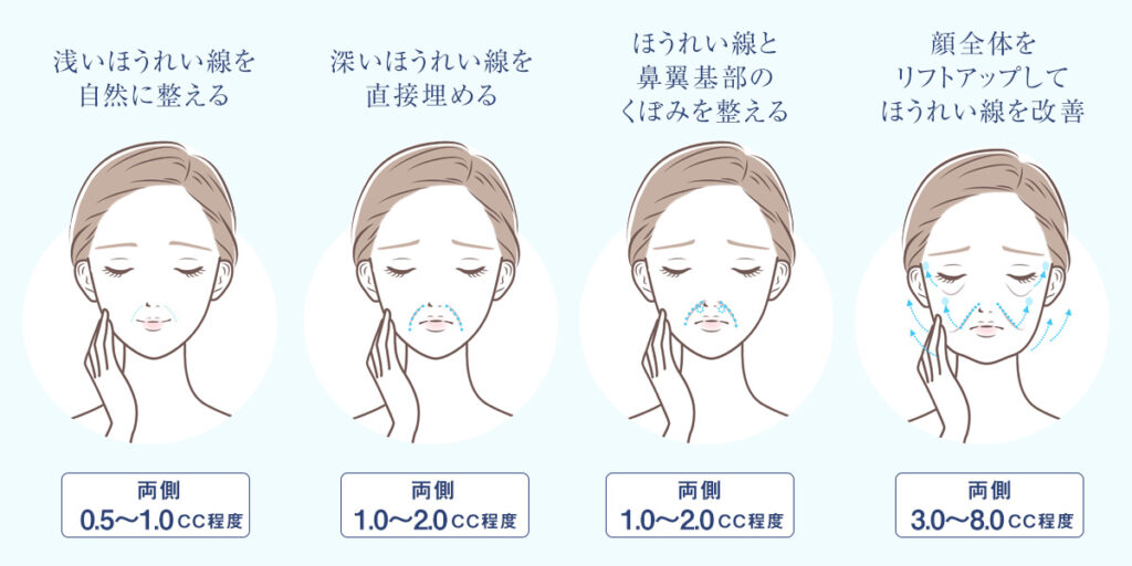 ほうれい線のヒアルロン酸注入量の目安・浅いほうれい線を自然に整える（両側0.5～1.0cc）・深いほうれい線を直接埋める（両側1.0～2.0cc）・ほうれい線と鼻翼基部のくぼみを整える（両側1.0～2.0cc）・顔全体をリフトアップしてほうれい線を改善（両側3.0～8.0cc）